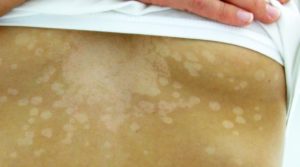 Pityriasis versicolor