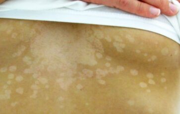 Pityriasis versicolor