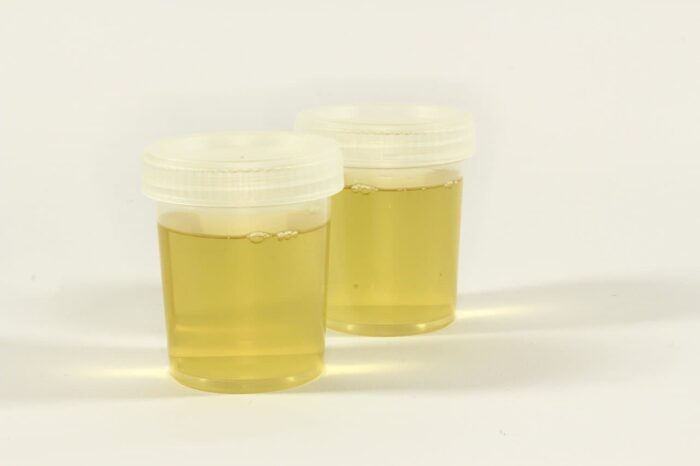 Urine fiole couleur